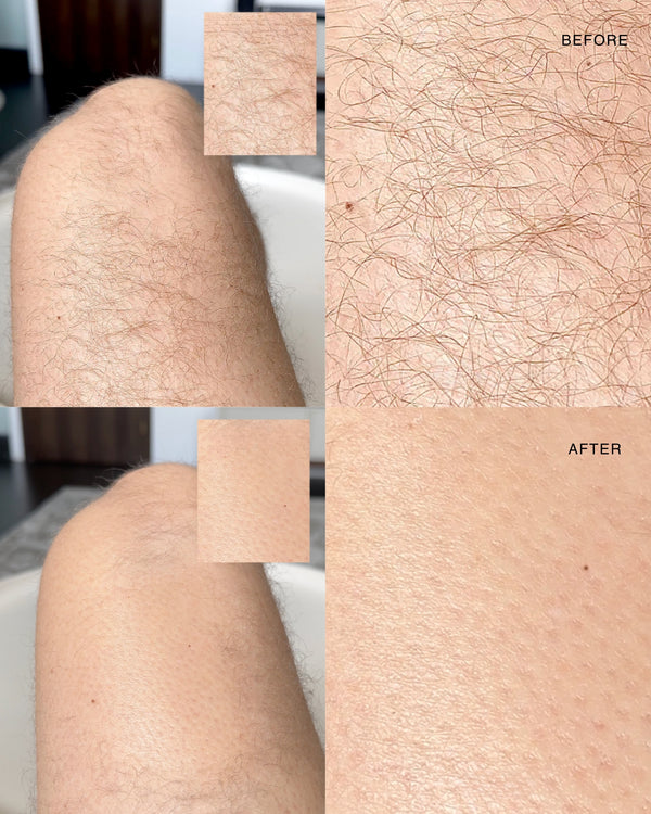 Exfoliating hair removal drop